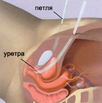 стрессовое недержание мочи у женщин